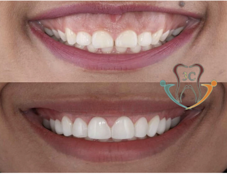 Điều trị thẩm mỹ phức hợp răng – nướu (phẫu thuật cười hở lợi)